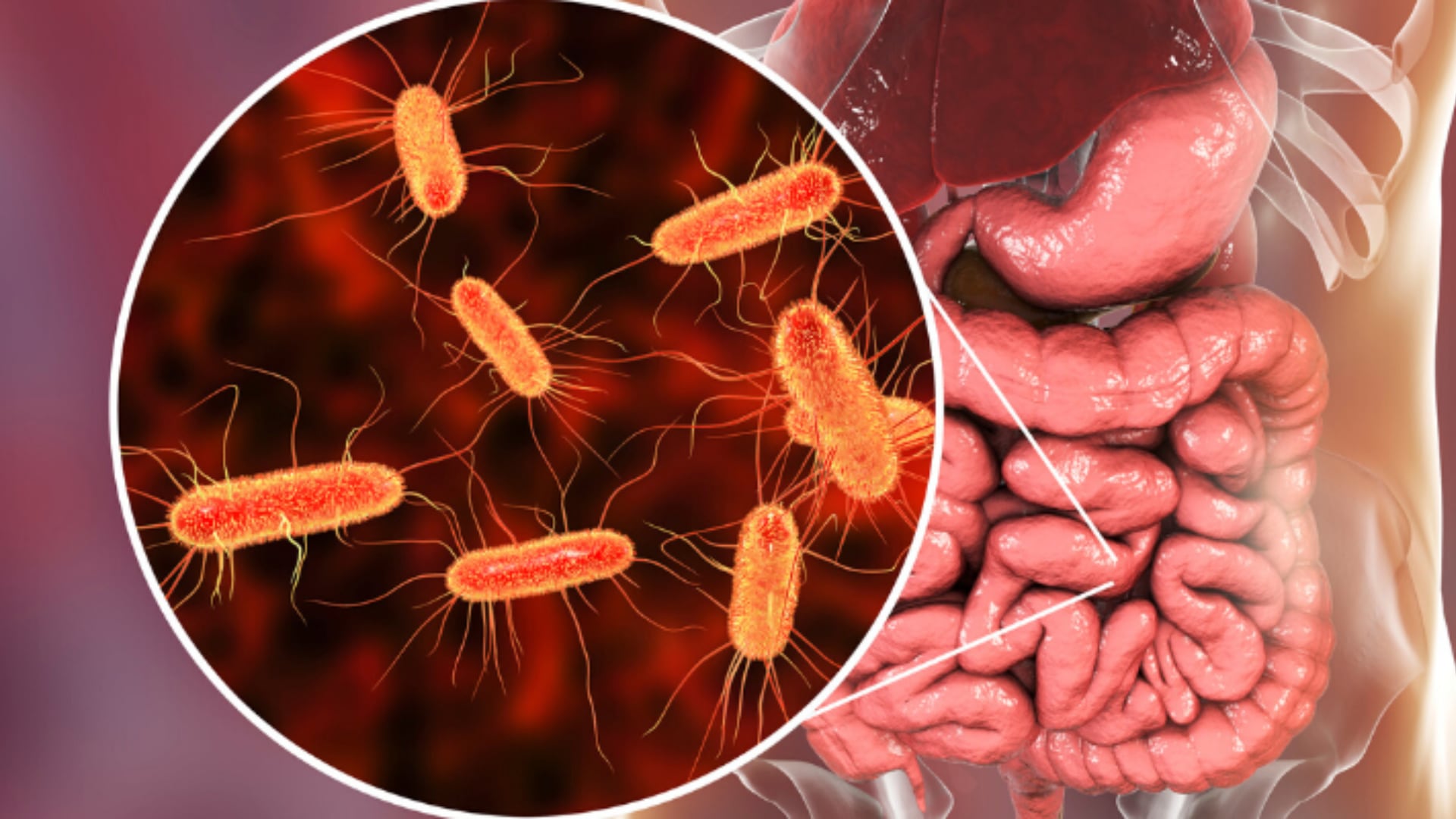 E. coli enterohemorrágica, vinculada a carne picada, puede generar desde diarrea leve hasta graves daños renales, especialmente en niños pequeños (Tecnosoluciones Integrales)