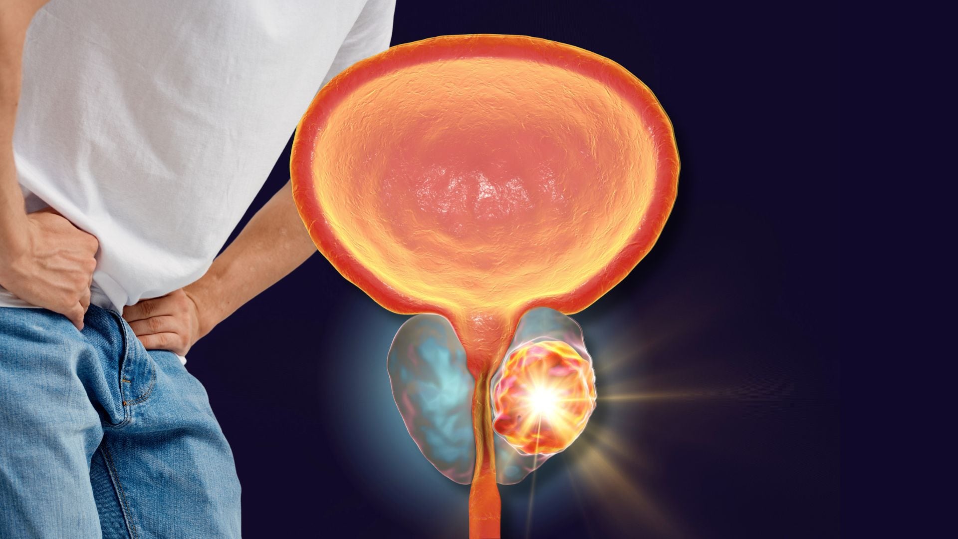 El 75% de los pacientes con cáncer de próstata pueden curarse si se detectan y tratan en fases tempranas (Montaje Infobae)