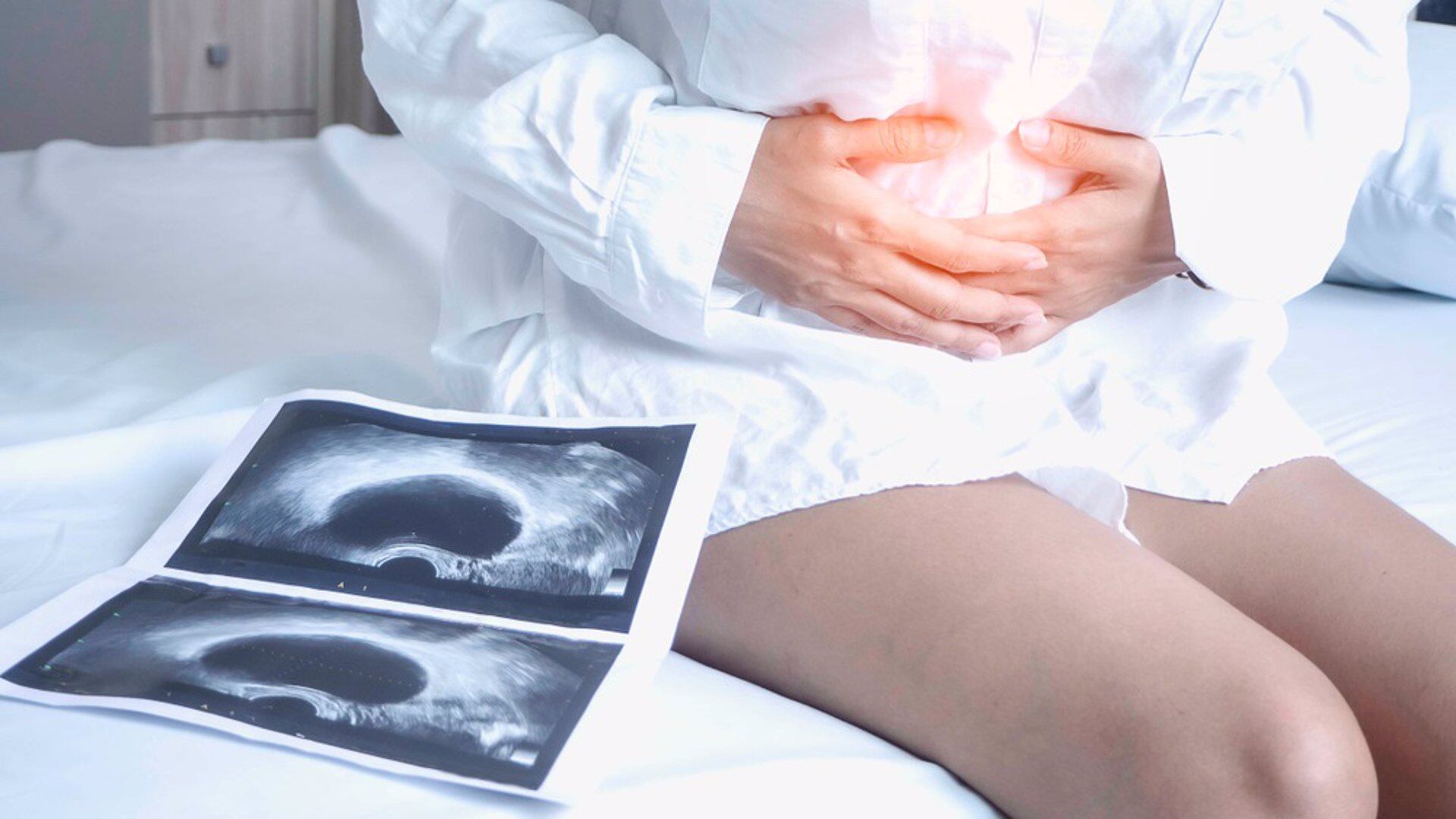 La detección tardía es el principal desafío: la mayoría de los casos se identifican cuando el tumor ya se ha expandido CLÍNICA MARGEN 