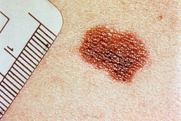 Día Mundial del Melanoma: los últimos avances en los tratamientos de un tipo de tumor que crece en la Argentina