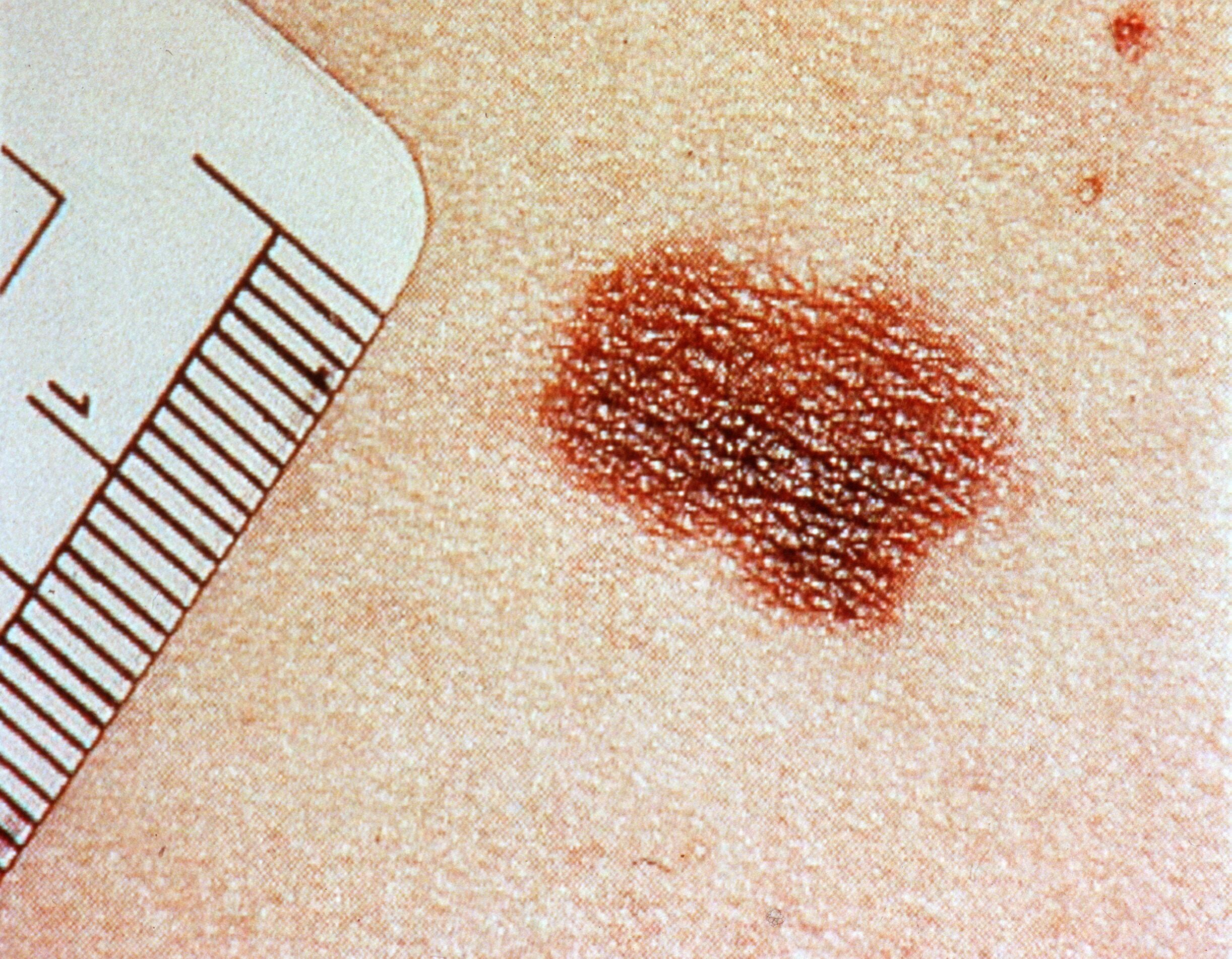 Día Mundial del Melanoma: los últimos avances en los tratamientos de un tipo de tumor que crece en la Argentina