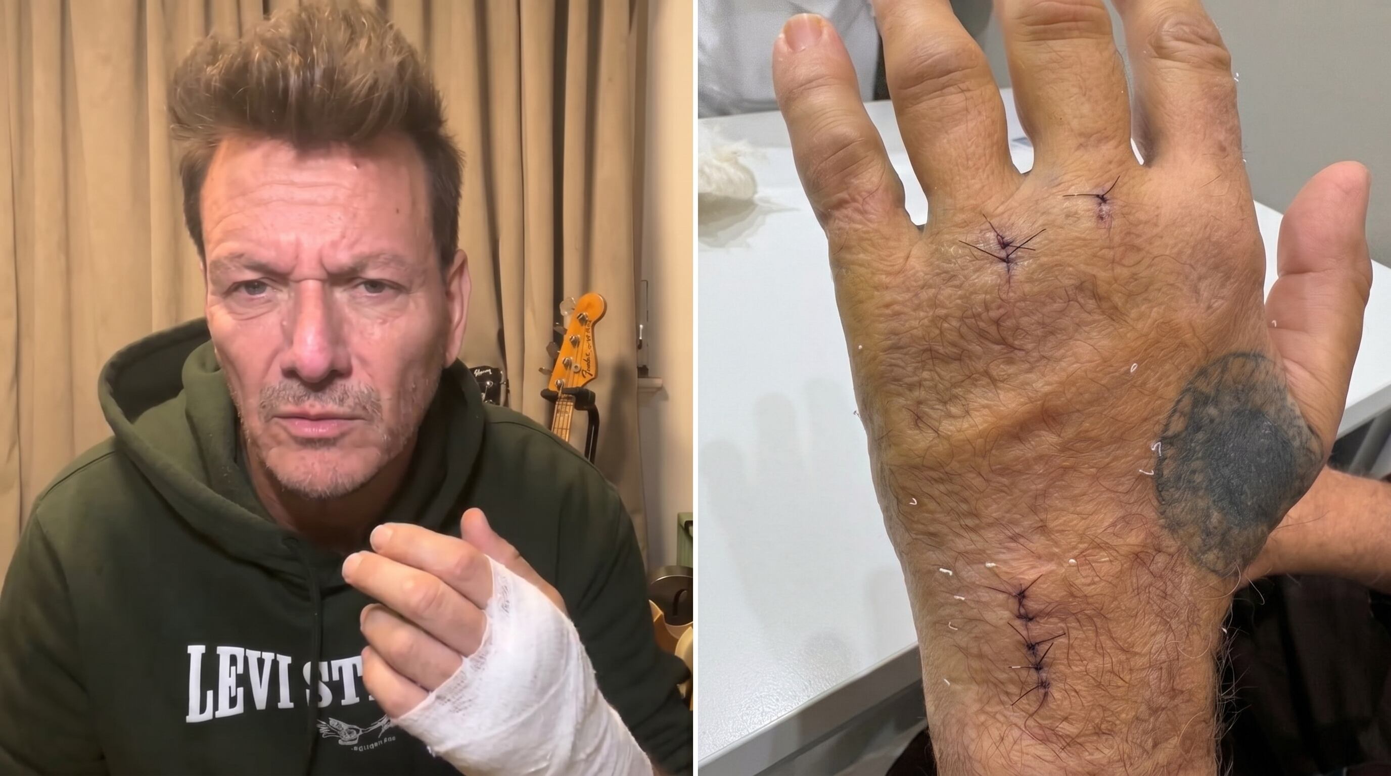 Javier Malosetti compartió cómo se encuentra su mano luego de la cirugía tras el accidente