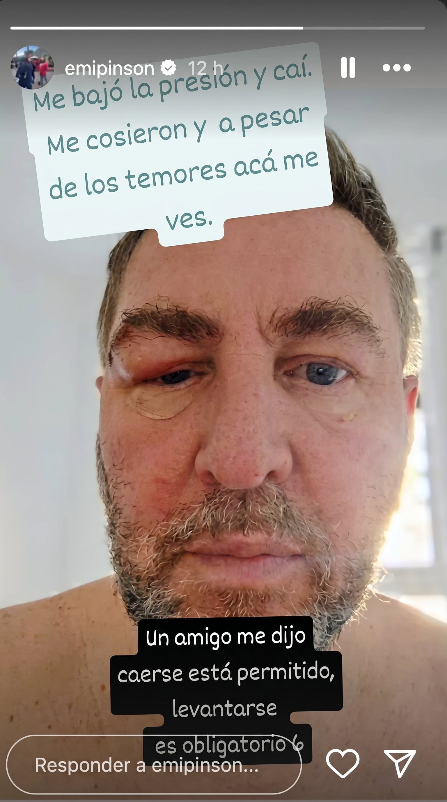 El periodista Emiliano Pinsón causó preocupación al mostrarse con un gran hematoma en su rostro