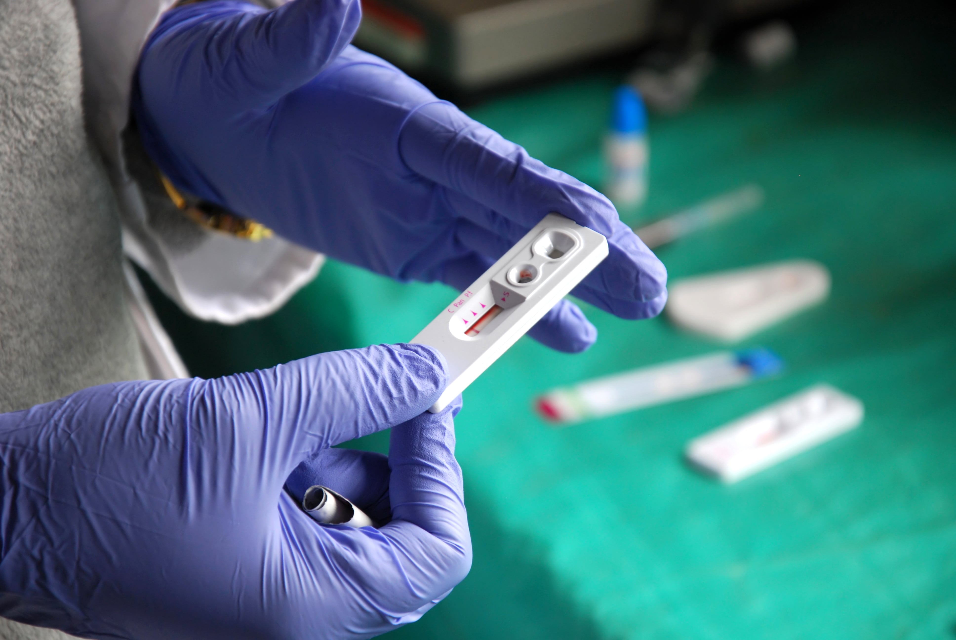 Un test de VIH, el Ministerio de Salud reitera la importancia de realizarse la prueba al menos una vez al año, si se mantiene una vida sexual activa. (AdobeStock)