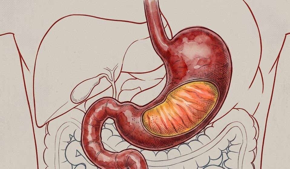 Detectar síntomas tempranos de cáncer de estómago aumenta las posibilidades de diagnóstico y tratamiento exitoso (Imagen Ilustrativa Infobae)