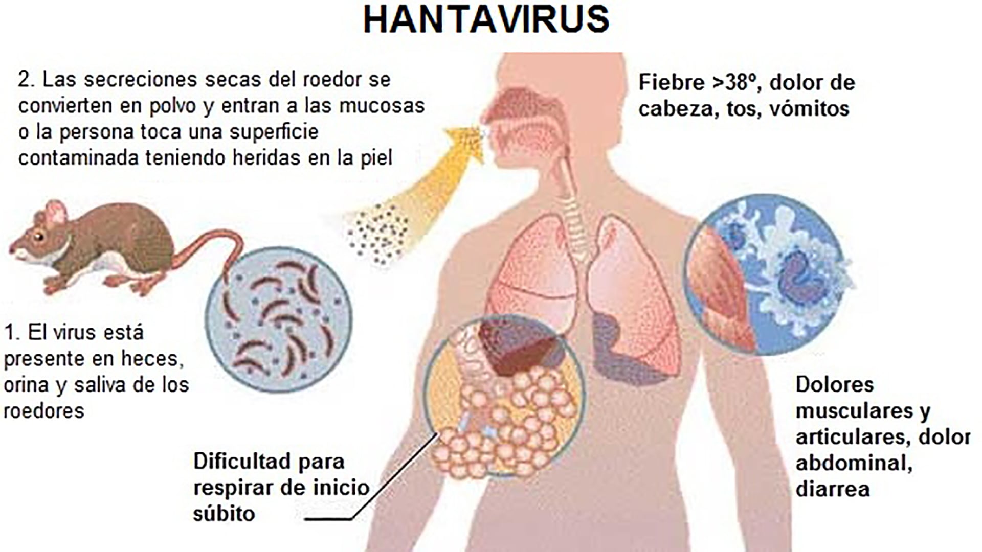 El síndrome cardiopulmonar por hantavirus puede evolucionar en horas a insuficiencia respiratoria aguda y requiere atención médica intensiva. 