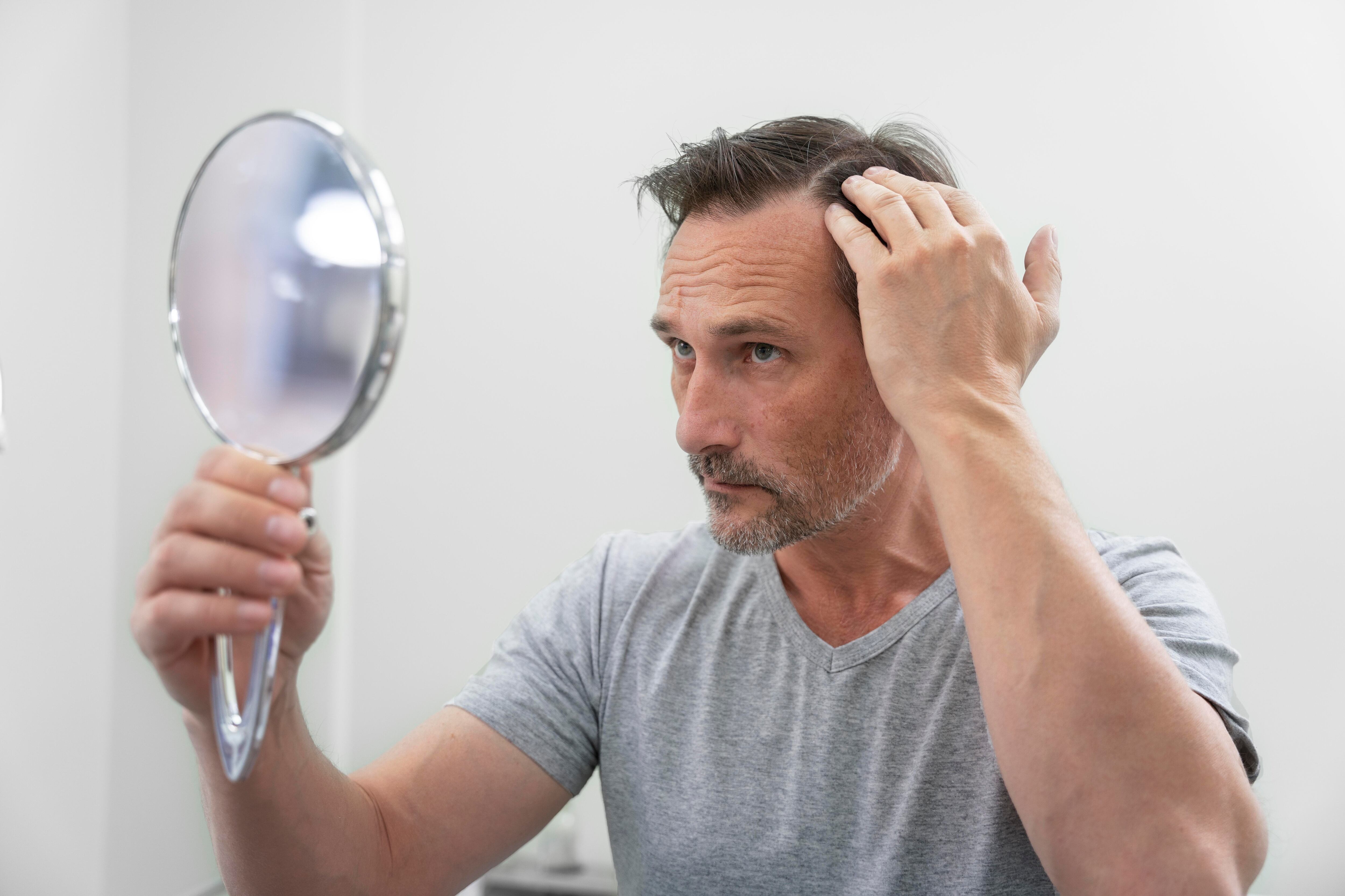 La caída del cabello responde a causas como la genética, la edad, los cambios hormonales y la falta de nutrientes esenciales (Freepik)