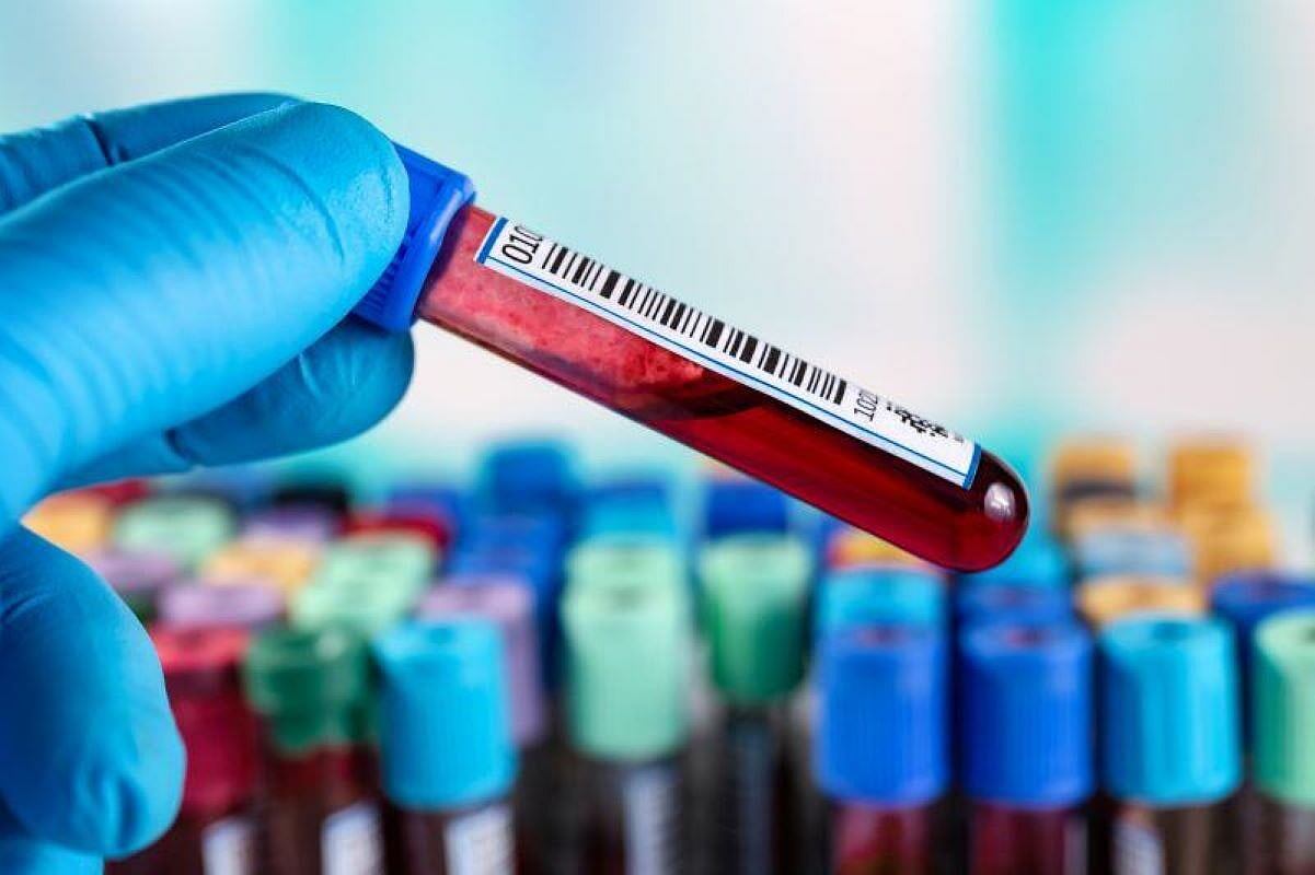 Análisis de sangre de nueva generación mejora la detección del cáncer de próstata agresivo