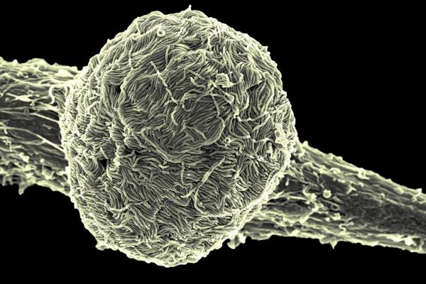 Brasil descartó uno de dos casos sospechosos de ébola: el paciente que queda por confirmar está internado en grave estado