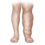 Celulitis, linfedema y lipedema: cómo identificarlas y cuándo consultar con un especialista