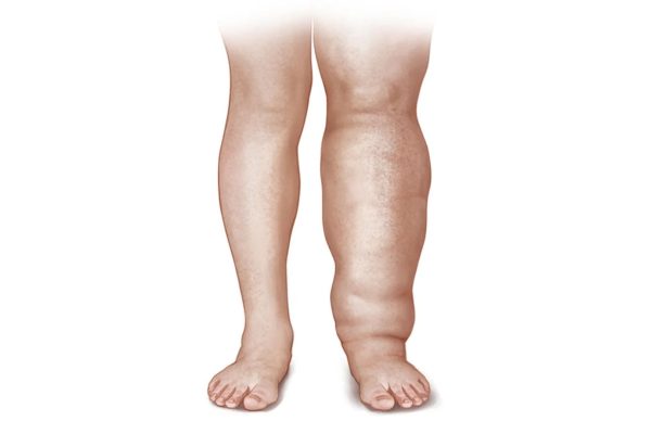 Celulitis, linfedema y lipedema: cómo identificarlas y cuándo consultar con un especialista