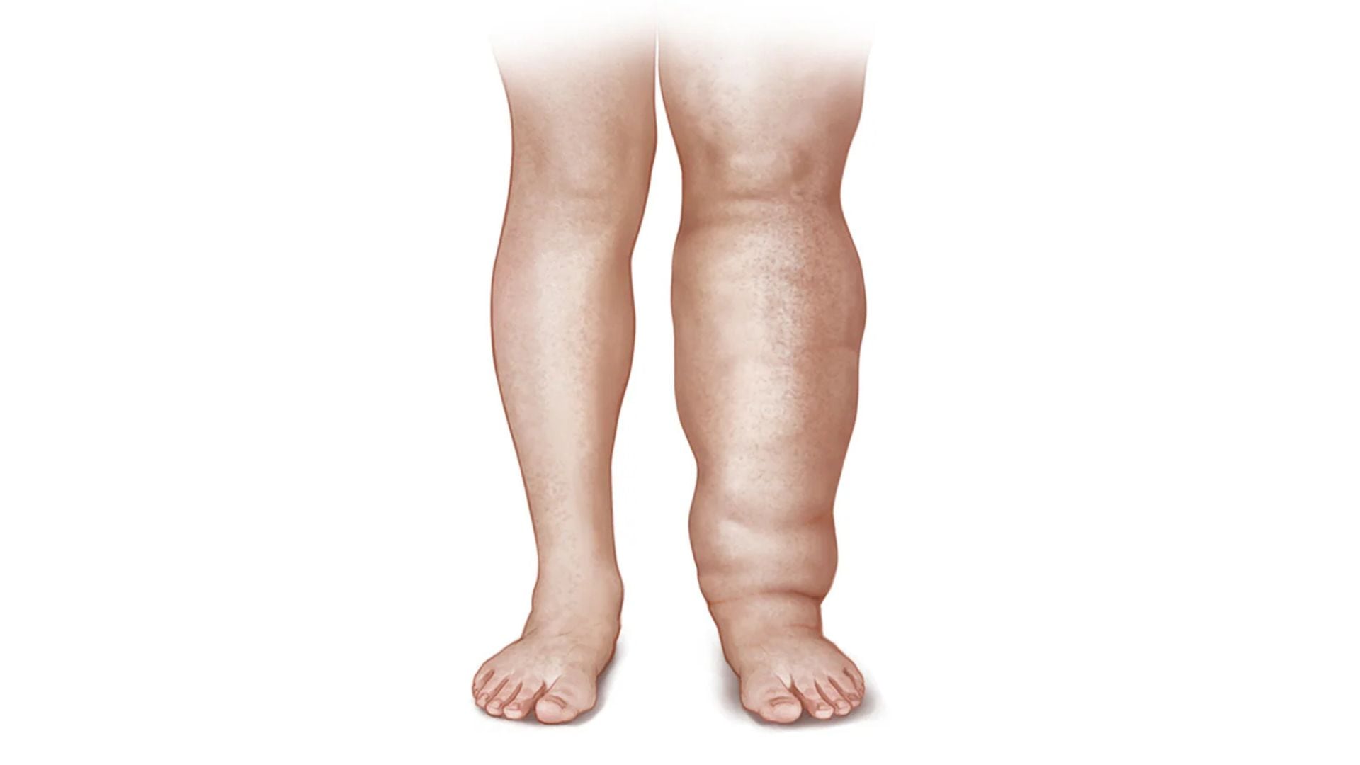 Celulitis, linfedema y lipedema: cómo identificarlas y cuándo consultar con un especialista