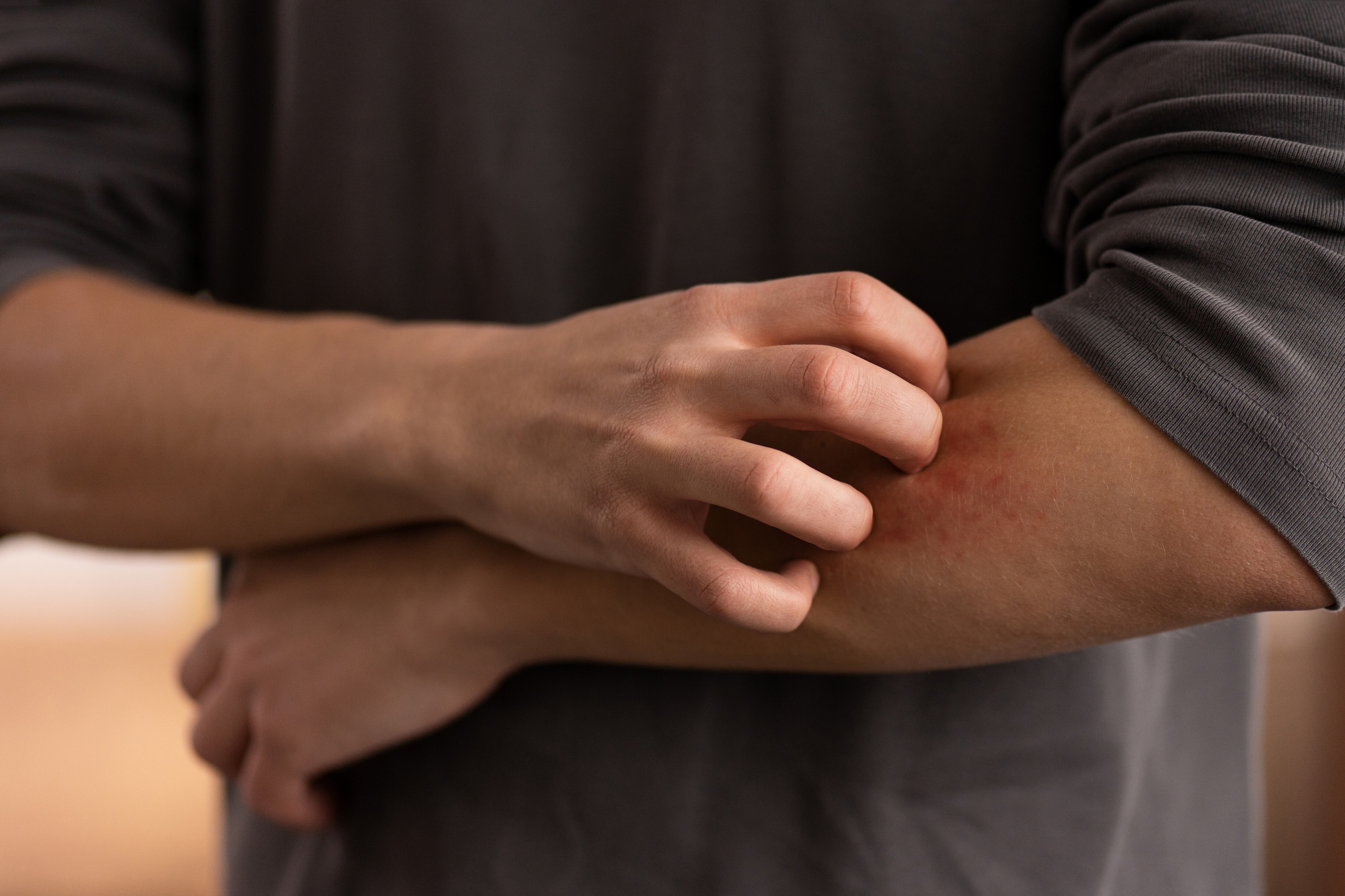 Las reacciones alérgicas inmediatas a medicamentos aparecen en menos de una hora y pueden causar picor, ronchas, angioedema, falta de aire, mareo e hipotensión (Crédito: Freepik)