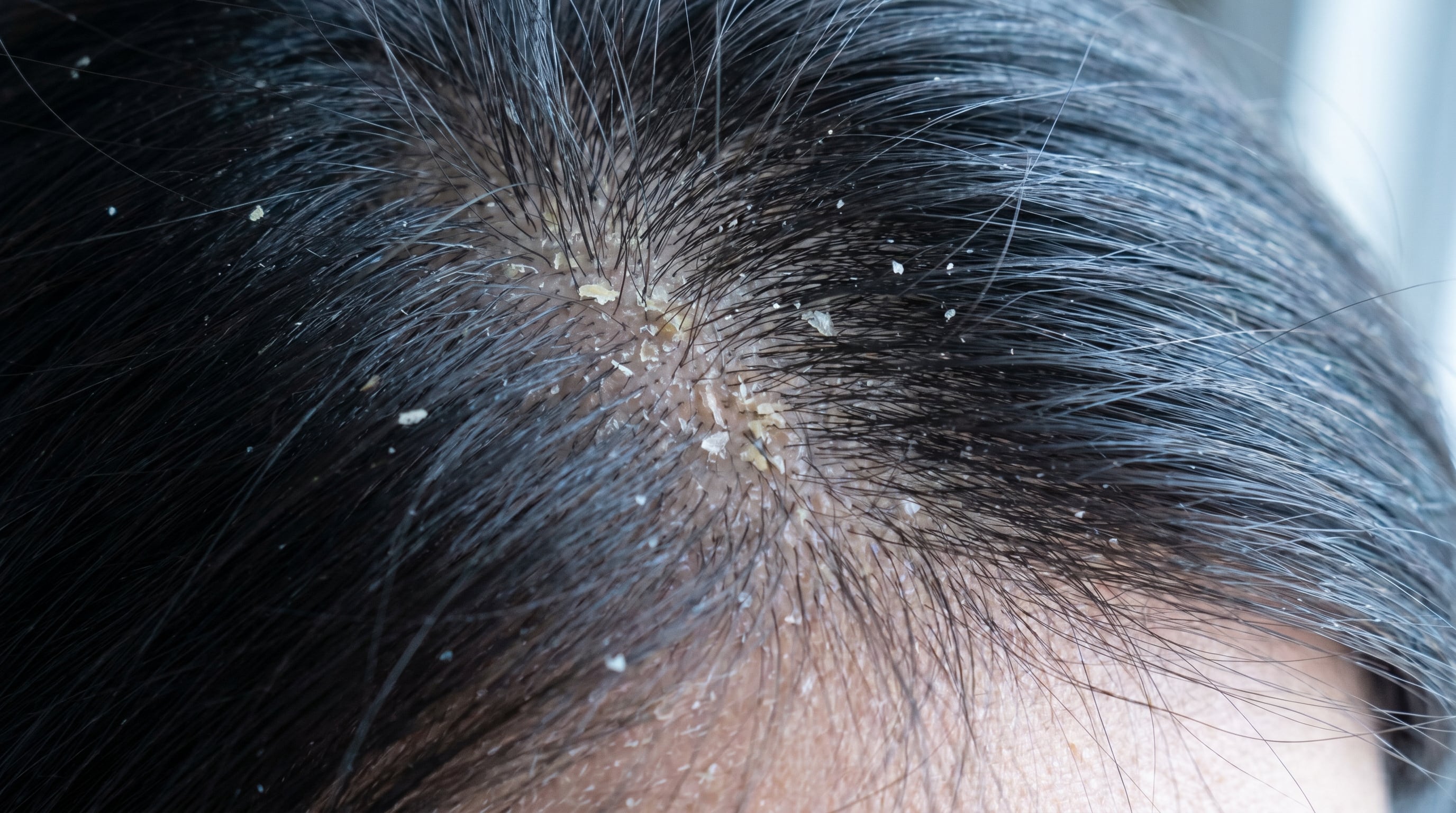 La caspa es una forma leve de dermatitis seborreica y se relaciona con una alteración del microbioma cutáneo por el crecimiento excesivo de Malassezia (Imagen Ilustrativa Infobae)