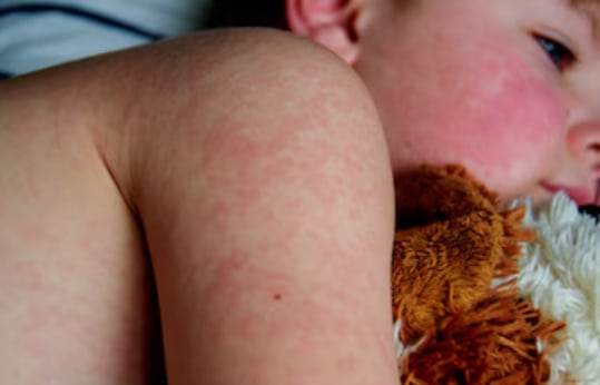 Autoridades de salud de California enfrentan una situación inédita tras hallar indicios del virus en análisis ambientales (Freepik)