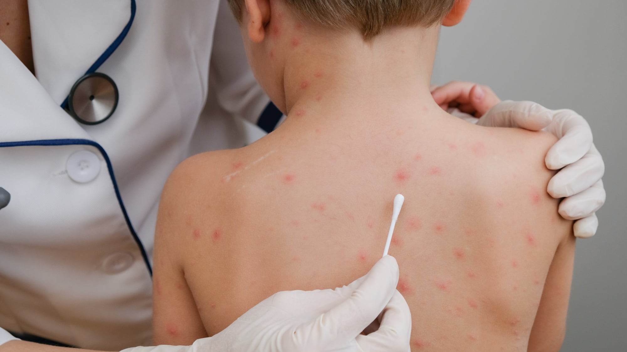 El sarampión es una enfermedad altamente contagiosa que afecta principalmente a niños y personas no vacunadas /Freepik