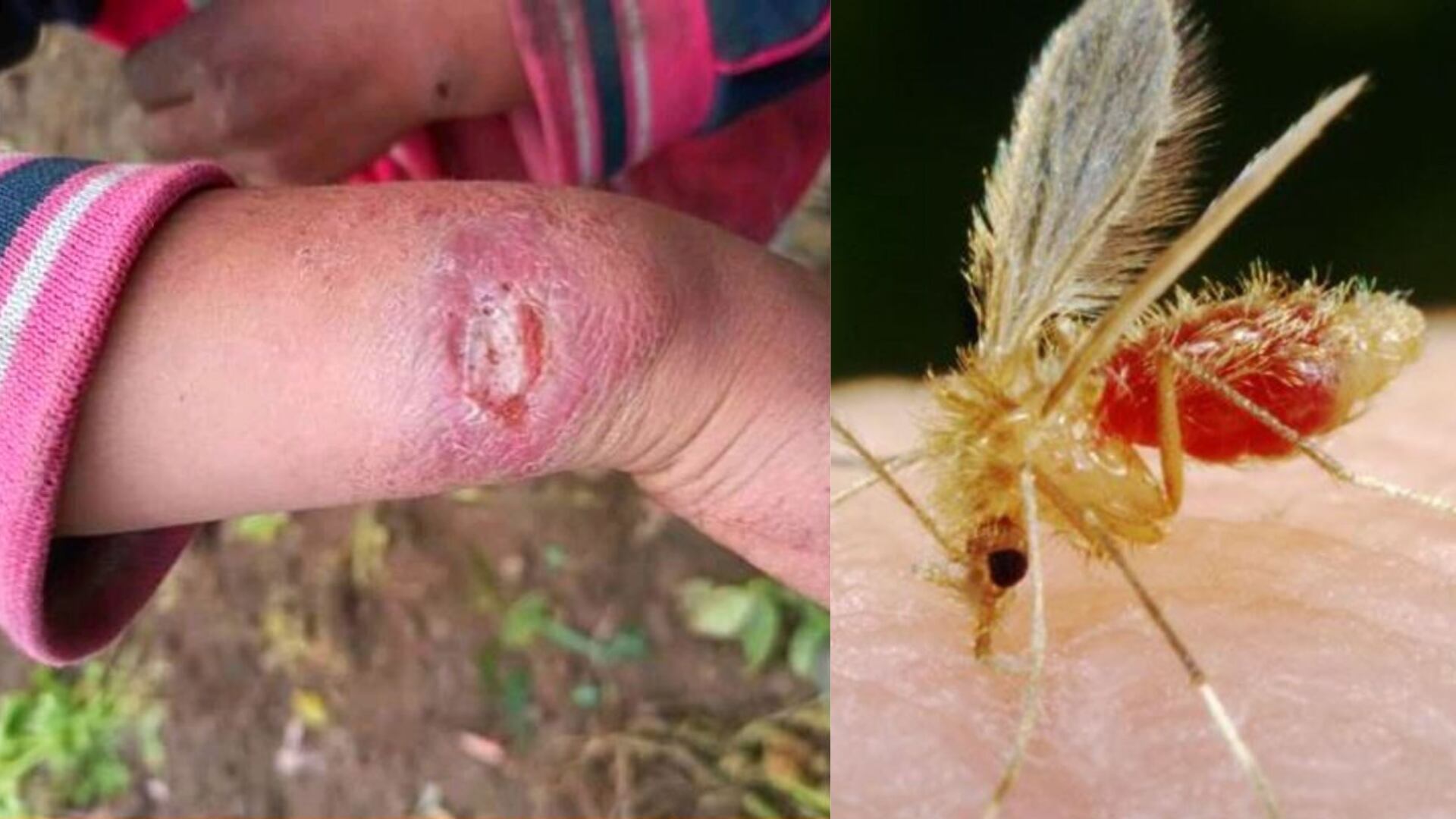 La leishmaniasis ya suma 1,067 casos en Panamá durante 2026 y continúa bajo vigilancia epidemiológica. (Composición: Infoabe)