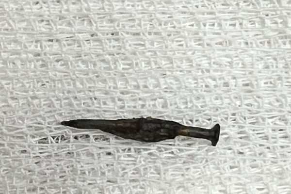 Por primera vez en un hospital público, extrajeron un clavo del intestino de un niño con cirugía magnética sin cicatrices