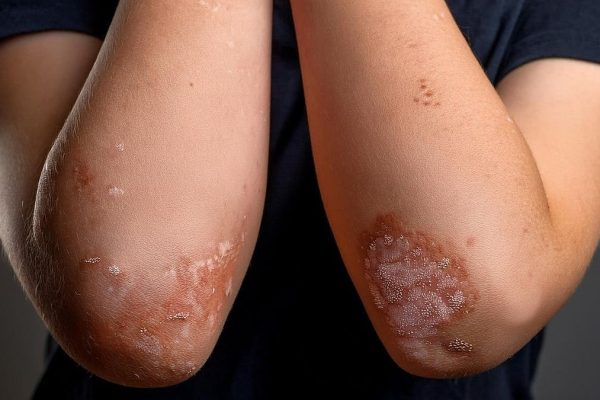 Psoriasis vinculada a la alteración de algunos dominios del sueño