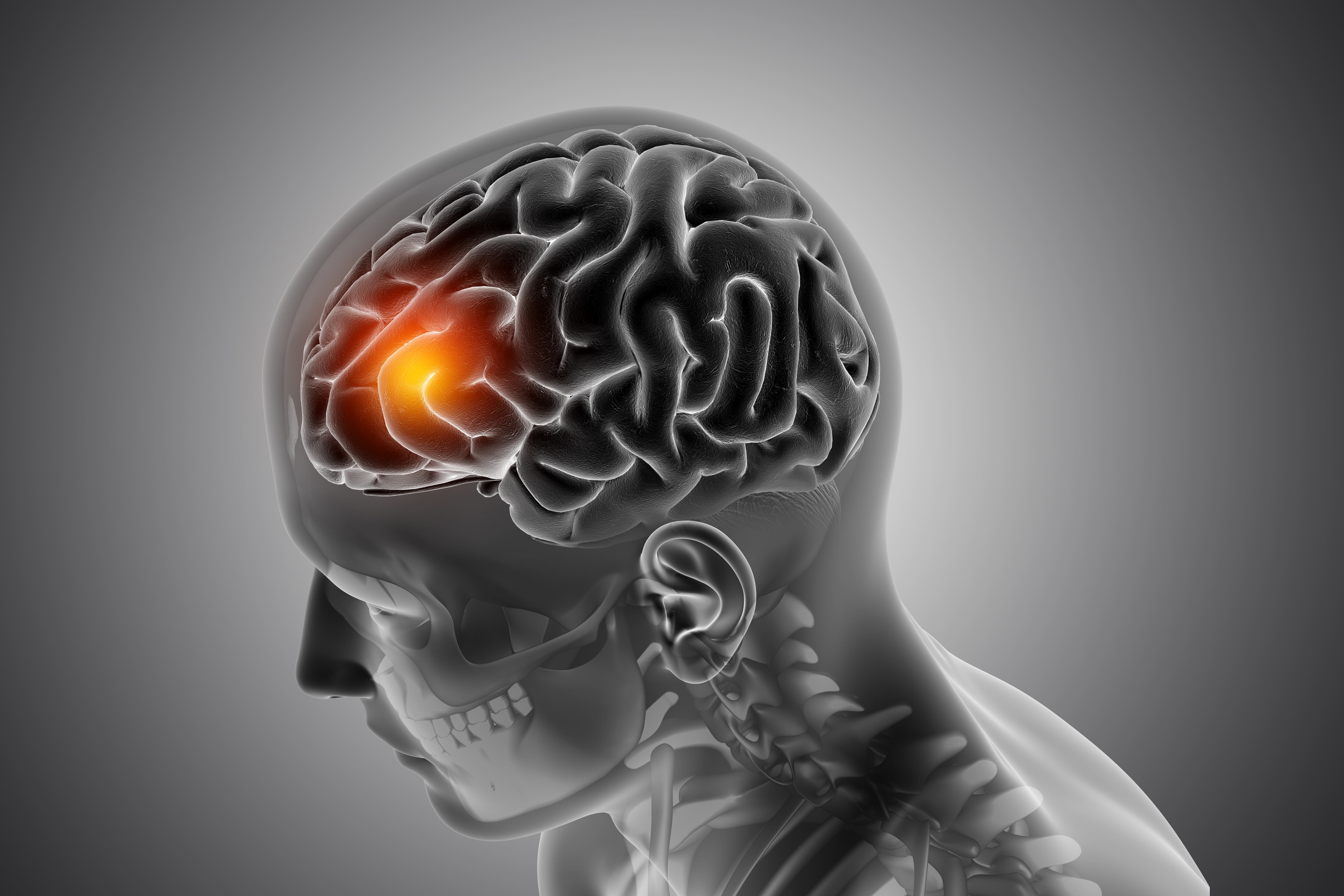 Este tipo de episodio representa solo el 13% de los ataques cerebrales, pero suele ser más letal que otras variantes 