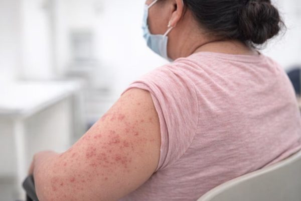Salud elimina requisito obligatorio de vacuna contra el sarampión para salir de Honduras