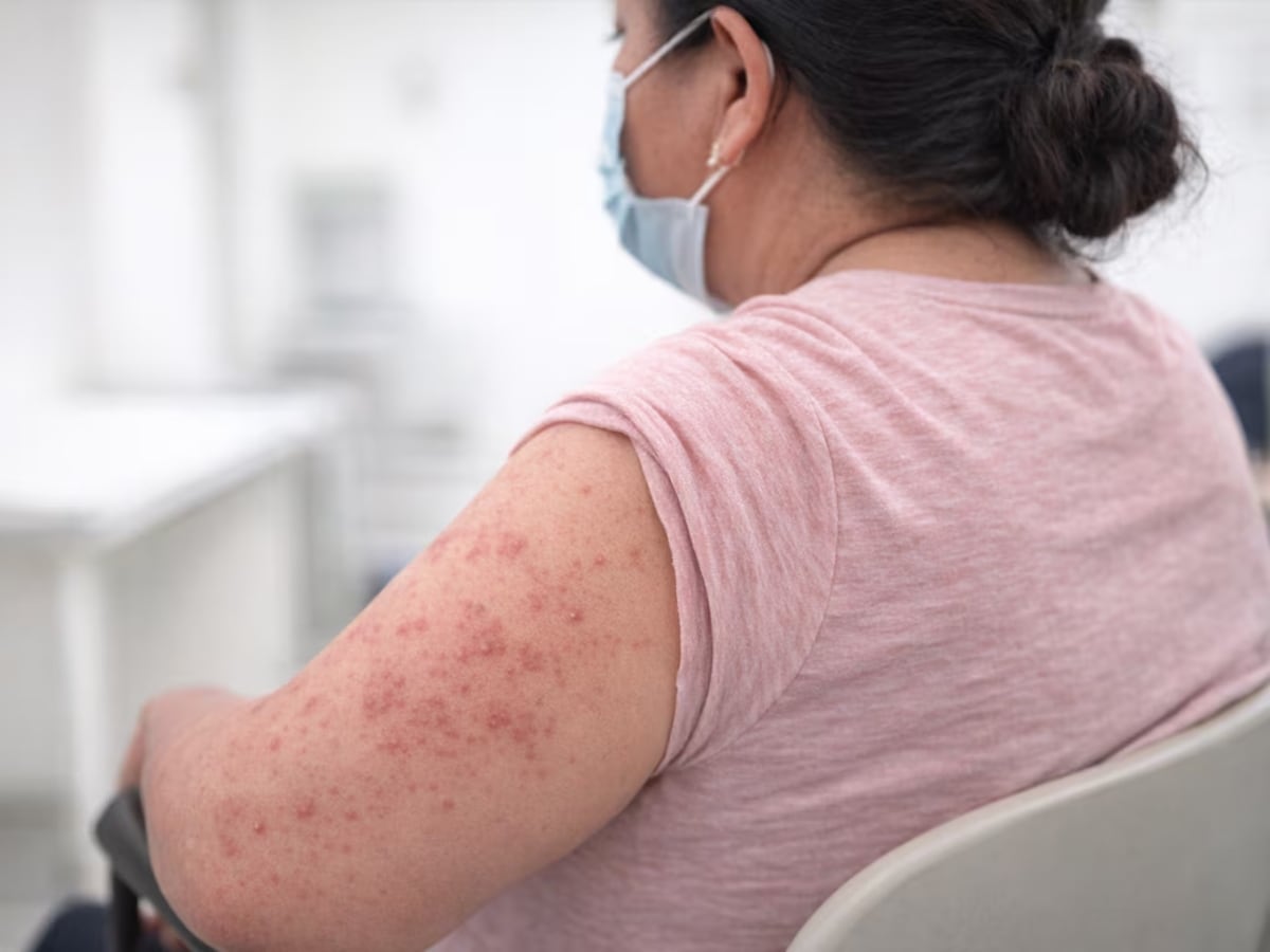 Salud elimina requisito obligatorio de vacuna contra el sarampión para salir de Honduras