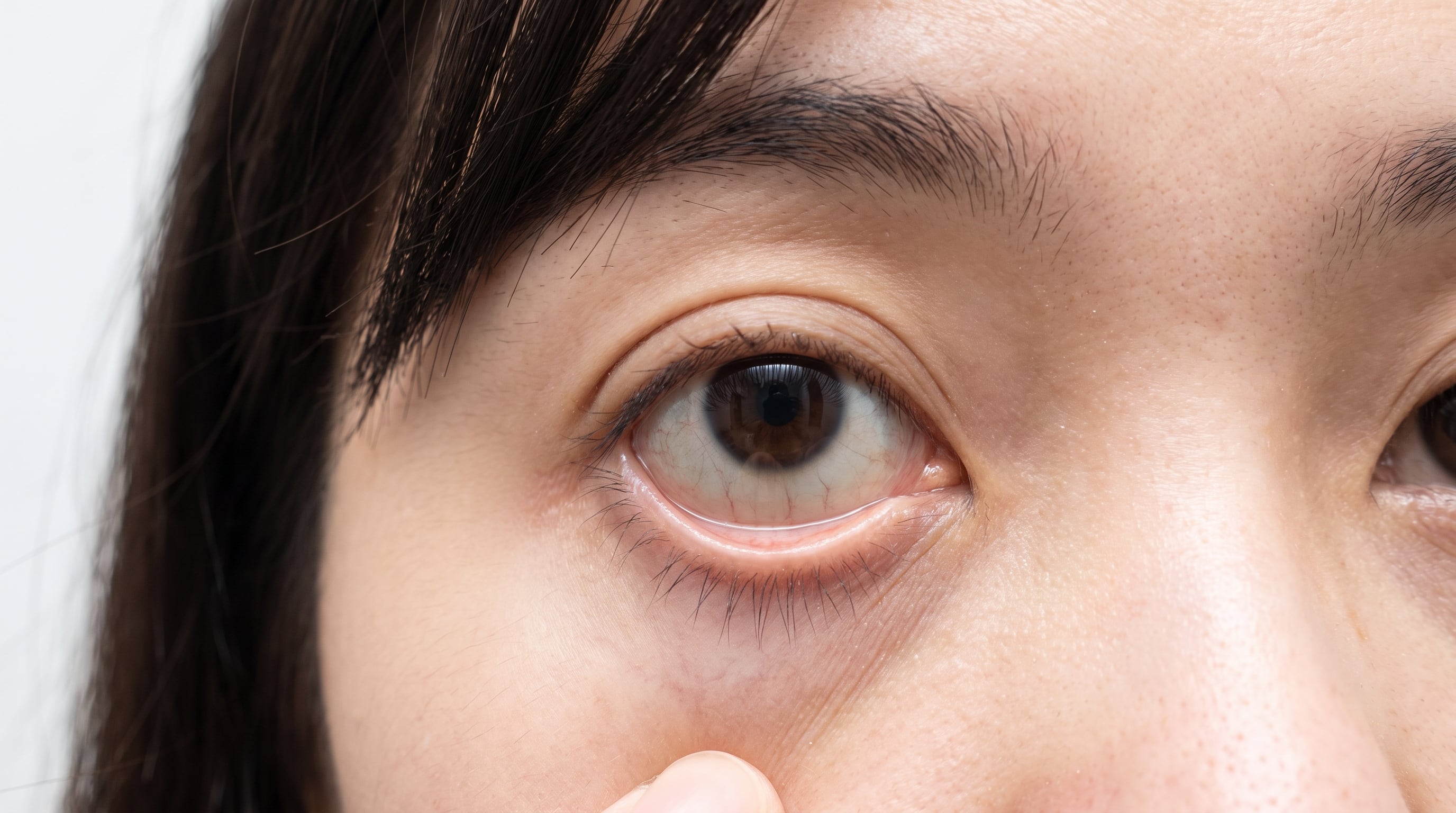 La palidez conjuntival en el párpado inferior aparece como un posible signo clínico de deficiencia de hierro por la disminución de la hemoglobina (Imagen Ilustrativa Infobae)