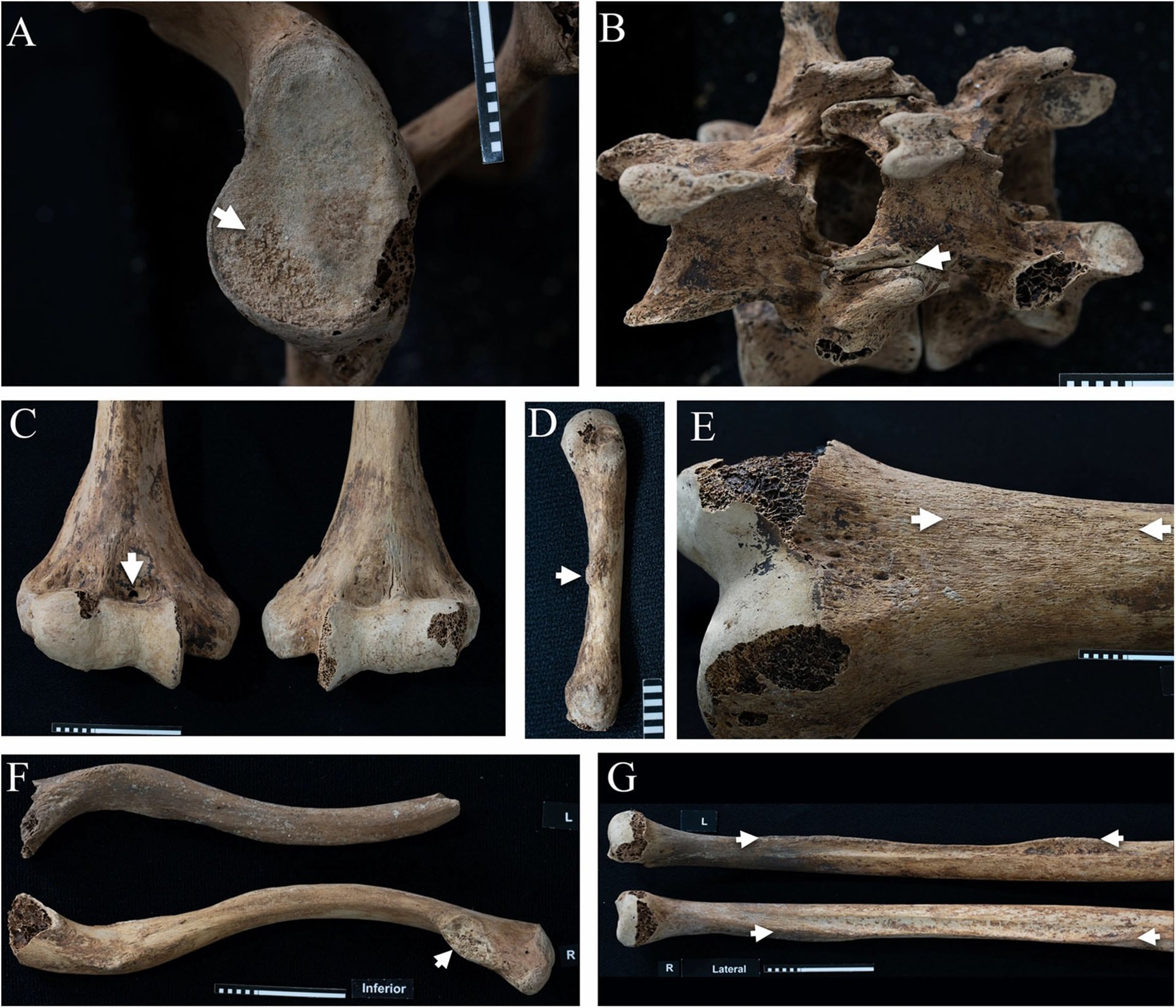 Los huesos de la princesa Ita registran lesiones articulares y marcas musculares que revelan una vida físicamente exigente hace más de tres mil setecientos años (Frontiers in Environmental Archaeology)