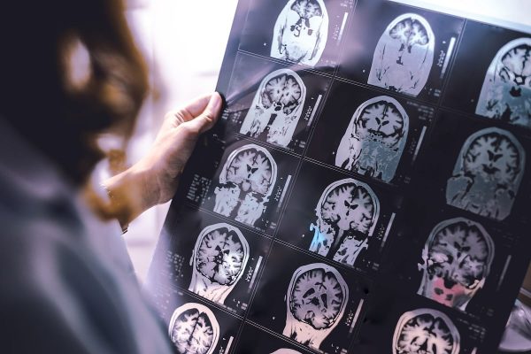 La IA puede detectar cicatrices de esclerosis múltiple en el cerebro que antes eran invisibles