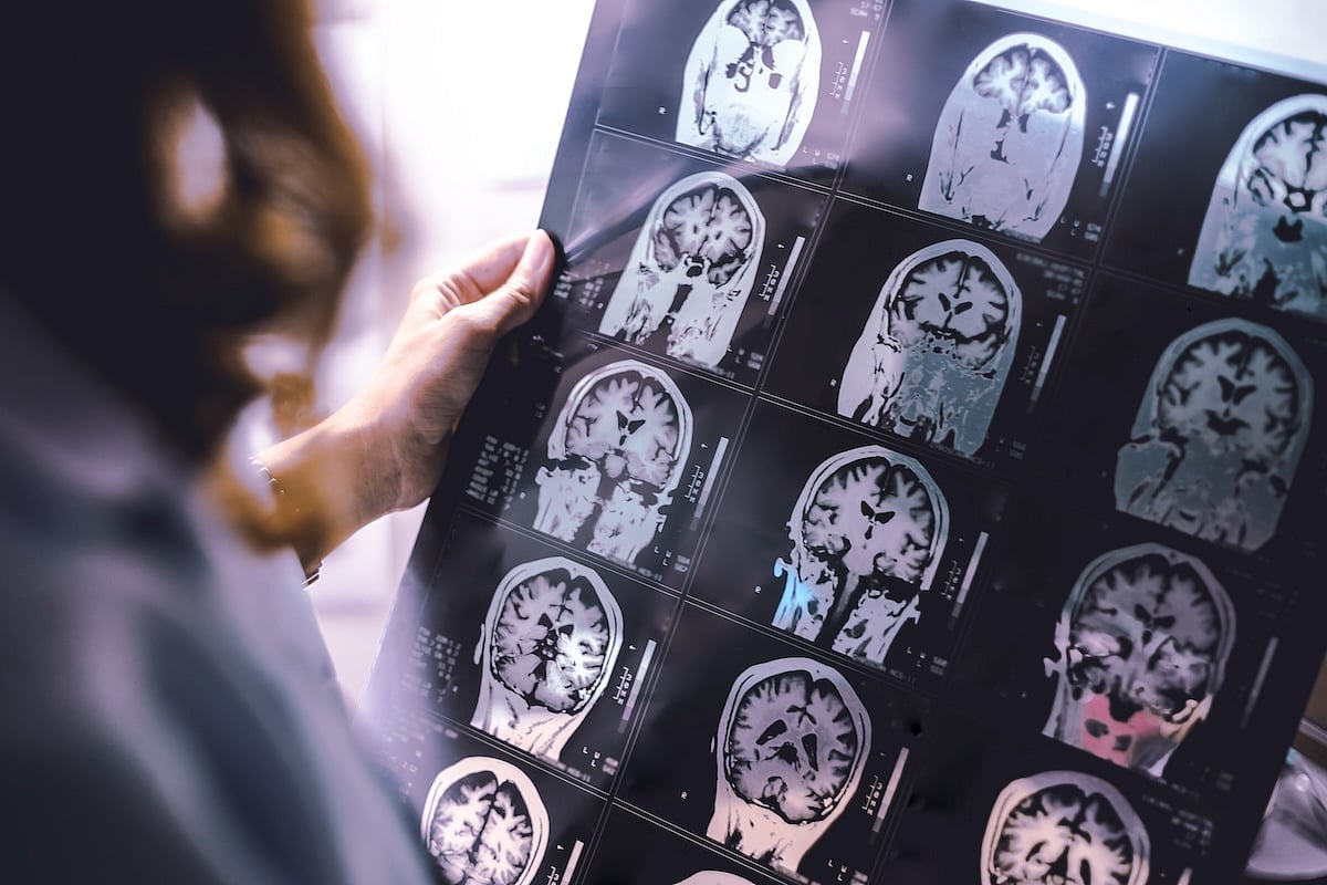 La IA puede detectar cicatrices de esclerosis múltiple en el cerebro que antes eran invisibles