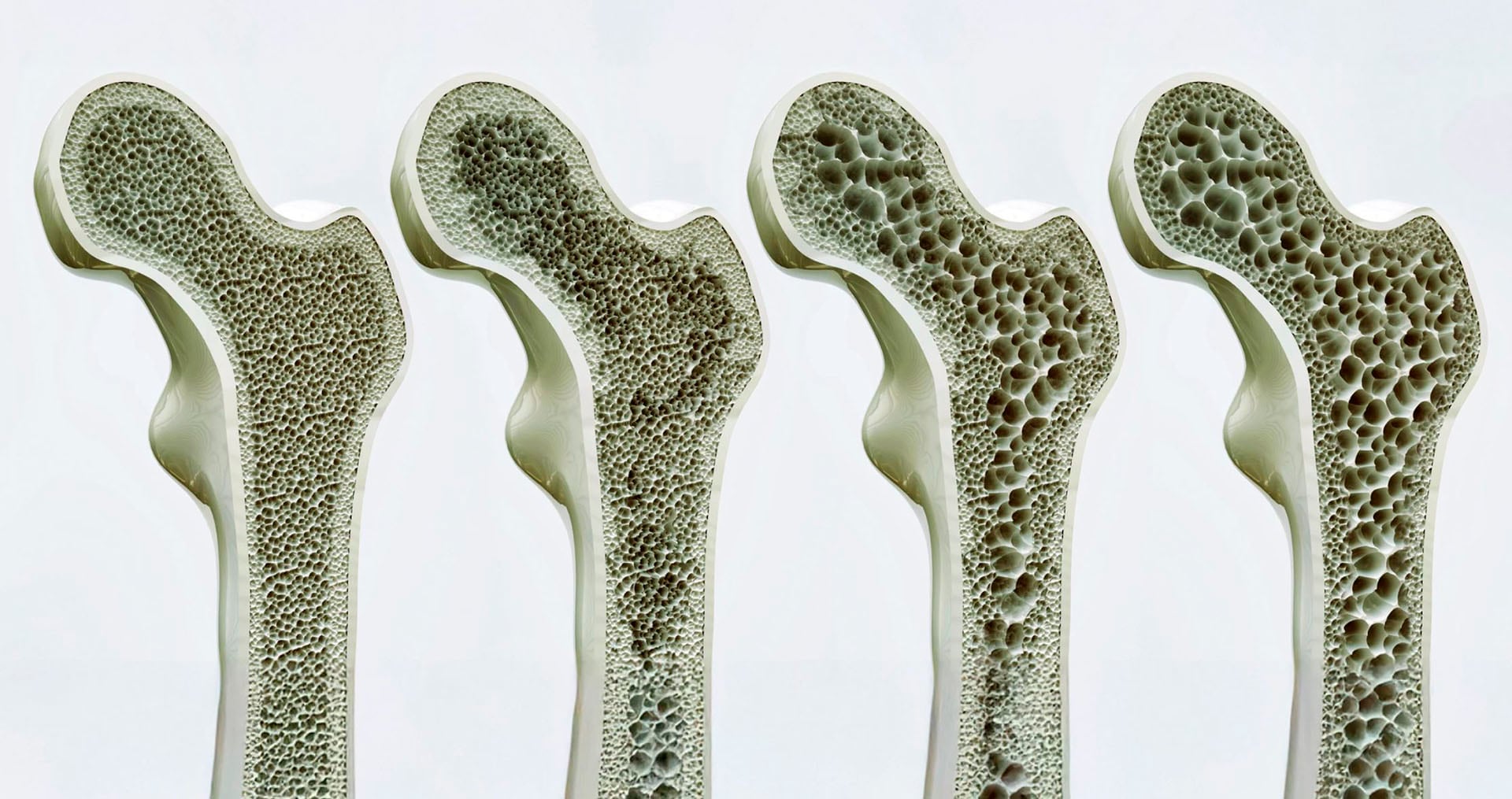 La osteoporosis puede estar detrás de una pérdida de estatura superior a 2,54 centímetros, sobre todo si aparece rápido o con postura encorvada