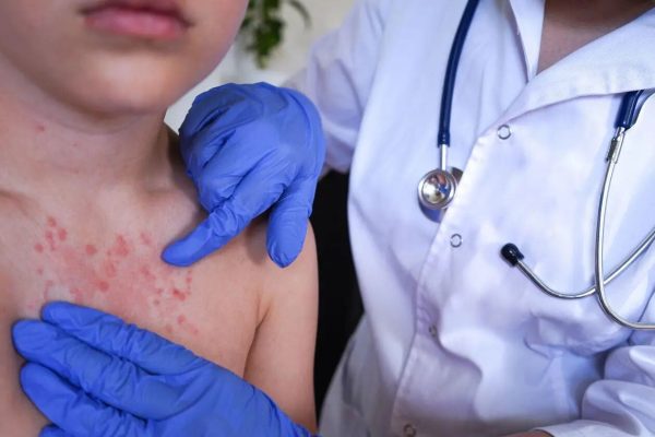 Sarampión avanza en Honduras: confirman cuatro nuevos contagios y los casos ya suman 10
