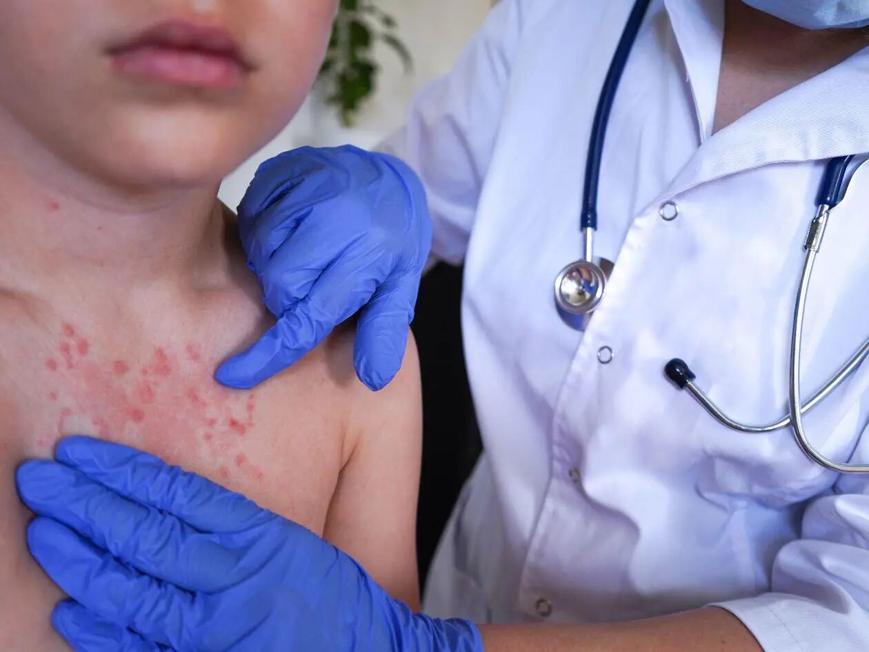 Sarampión avanza en Honduras: confirman cuatro nuevos contagios y los casos ya suman 10