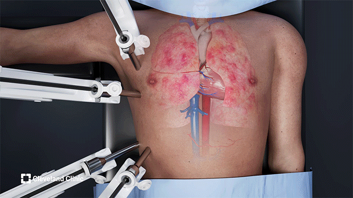 La cirugía, de siete horas, requirió solo pequeñas incisiones y redujo el tiempo de internación (Cleveland Clinic)