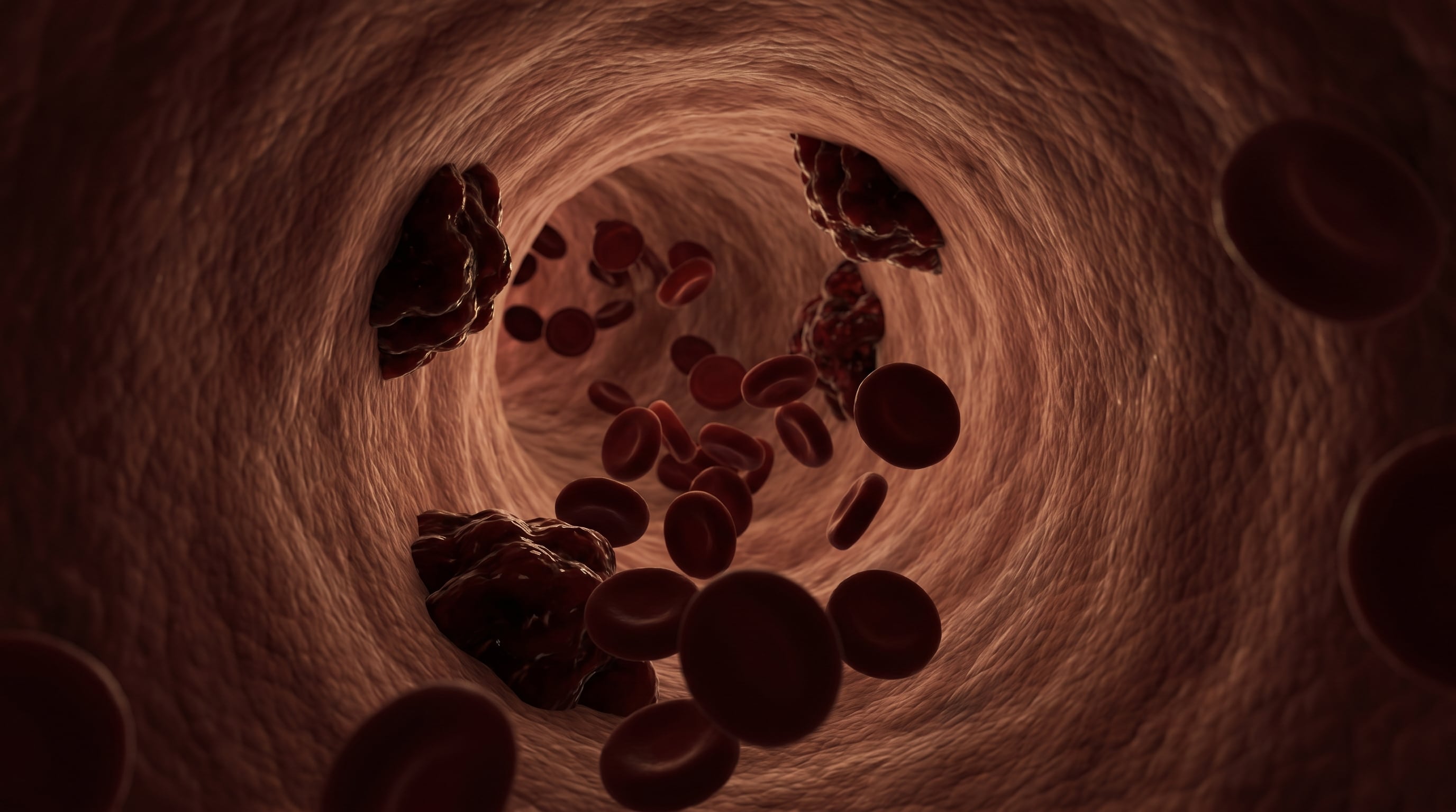 El estrés induce un estado de hipercoagulabilidad en la sangre y produce coágulos más grandes, densos y compactos (Imagen Ilustrativa Infobae)