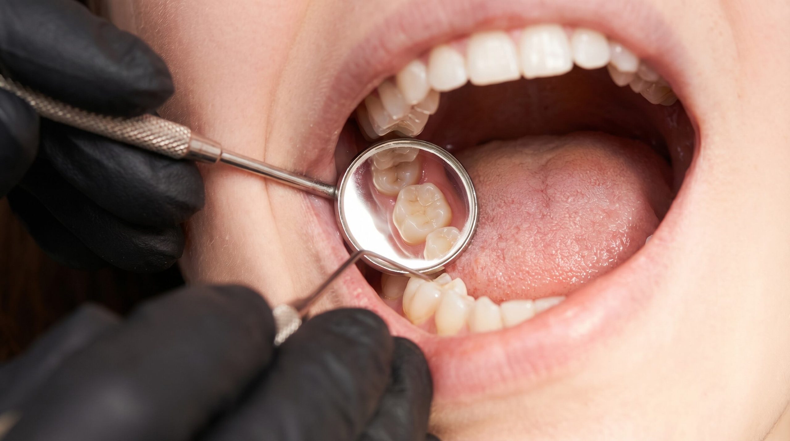 Extracción dental: qué alimentos no se deben comer y cuáles recomiendan los odontólogos