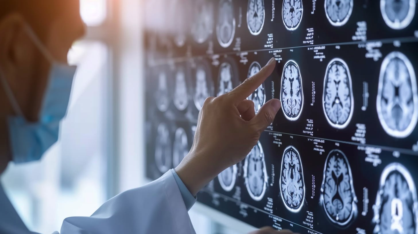 El modelo, obtenido con biopsias aportadas por hospitales y una red de familias e investigadores, busca estudiar un tumor cerebral infantil sin terapias efectivas y probar estrategias experimentales adaptadas al país (Imagen Ilustrativa Infobae)