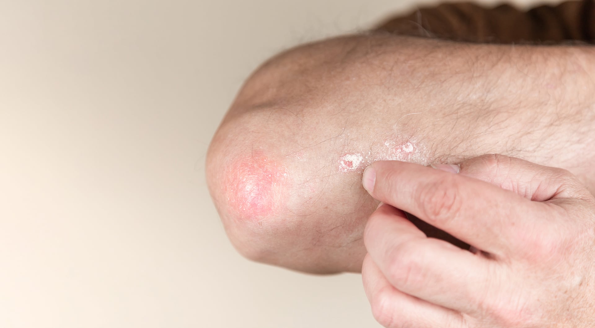En psoriasis suele aparecer lesiones rojas cubiertas por escamas blancas y secas (Imagen Ilustrativa Infobae)