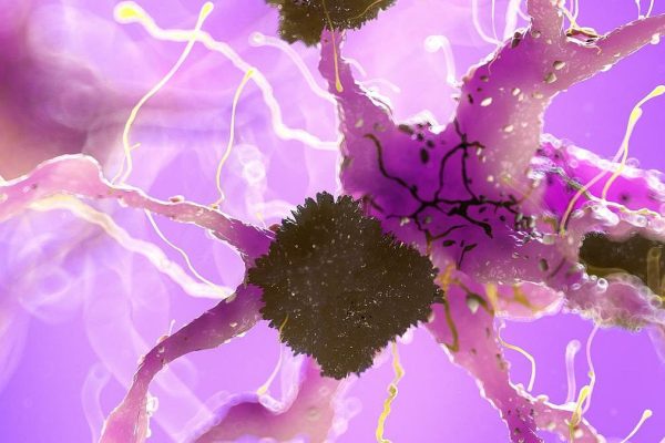 Problemas cardíacos relacionados con la reducción cerebral en personas con riesgo genético de Alzheimer
