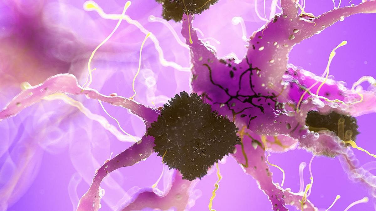 Problemas cardíacos relacionados con la reducción cerebral en personas con riesgo genético de Alzheimer