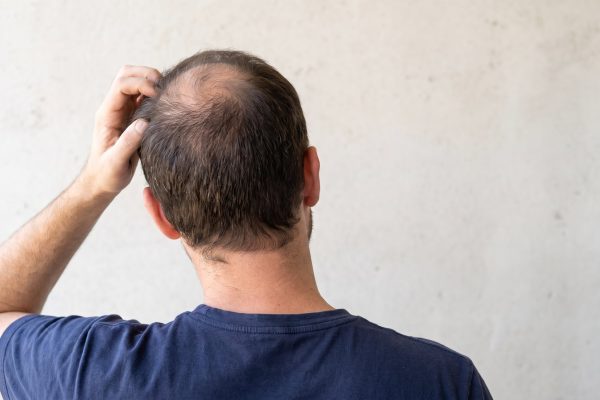 Qué hábitos favorecen el crecimiento del pelo y cuáles conviene evitar para prevenir la caída