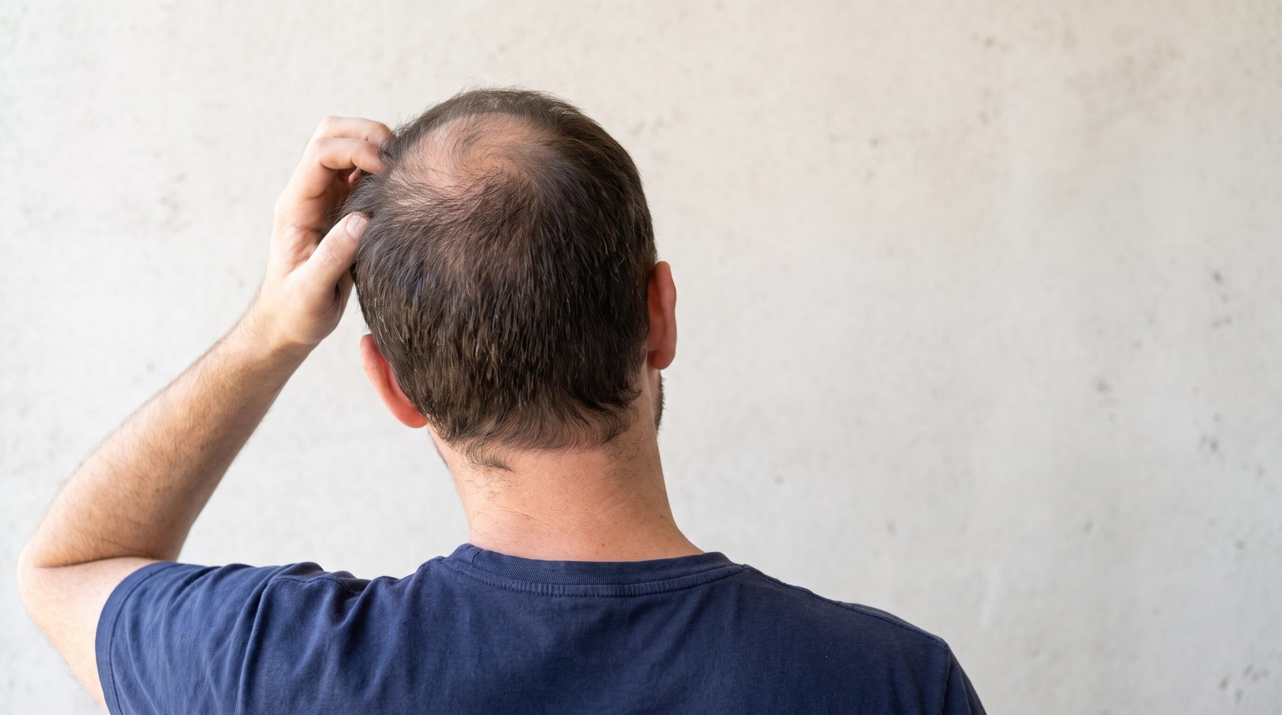 Alopecia areata: cuáles son los primeros signos y qué tratamientos existen para frenar la caída de cabello