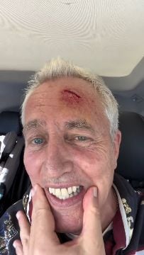 Marley se golpeó la cabeza contra una escalera y terminó con una sutura, la reacción de su hija Milenka: “Nana se hizo papá”