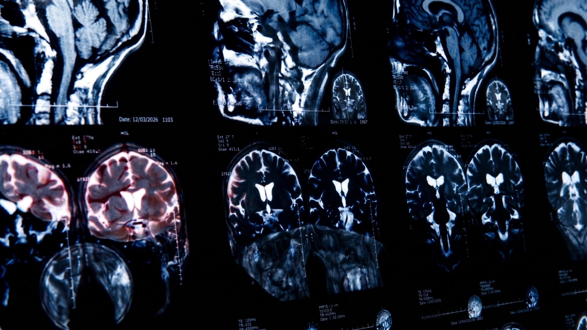 La infección desata cefalea, fiebre intensa y confusión, con una tasa de mortalidad que se acerca al cien por ciento. (Imagen ilustrativa IA Infobae)