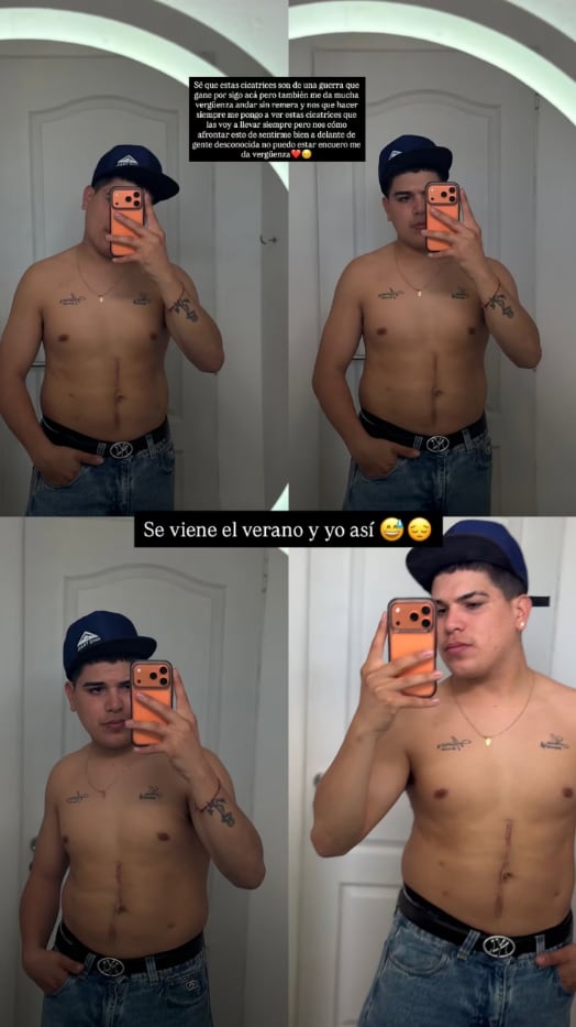 A más de un año del accidente, Thiago mostró las cicatrices que quedaron en su cuerpo (Instagram)