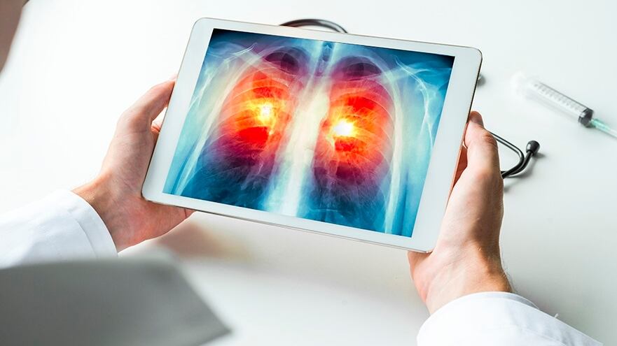 Los estudios por imágenes permiten detectar y caracterizar una lesión pulmonar, pero el diagnóstico definitivo requiere una biopsia o el análisis histológico del tejido extraído durante una cirugía.