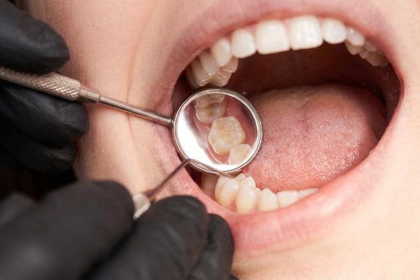 Qué ocurre cuando se deteriora el cemento de las carillas dentales y cómo identificar posibles filtraciones