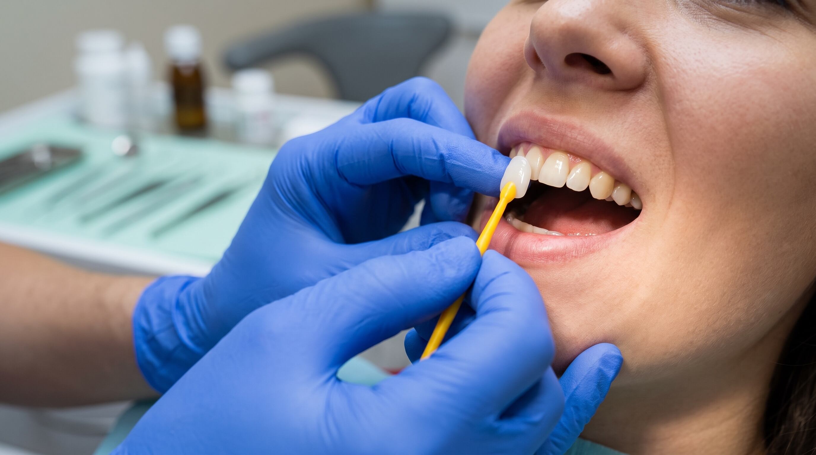 La colocación de carillas estéticas conserva estructuras vitales del diente como la dentina y parte del esmalte original (Imagen Ilustrativa Infobae)