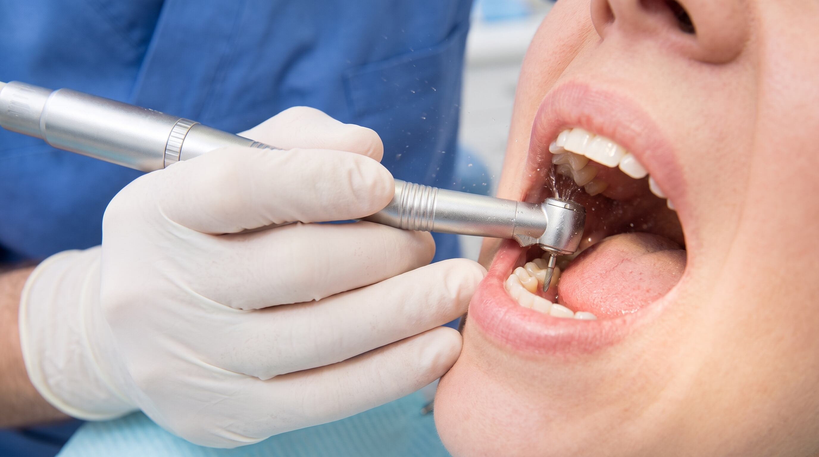 El uso de instrumental rotatorio sobre esmalte sano genera microgrietas en la estructura dental durante las intervenciones (Imagen Ilustrativa Infobae)