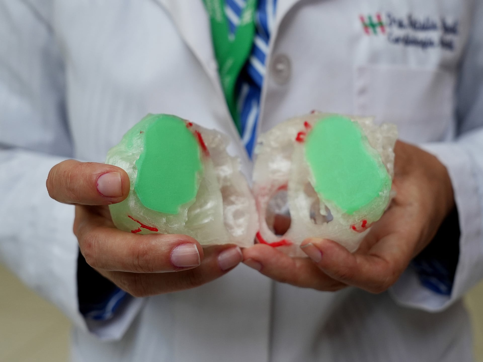 El modelo de corazón impreso en 3D que fue implantado